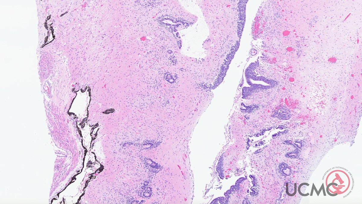 𝐂𝐚𝐬𝐞 𝐨𝐟 𝐭𝐡𝐞 𝐖𝐞𝐞𝐤: 12-year-old female with an ovarian mass.  Gross images and H&E stained section shown:
#pathology #PathTwitter #PediPath #GynPath
