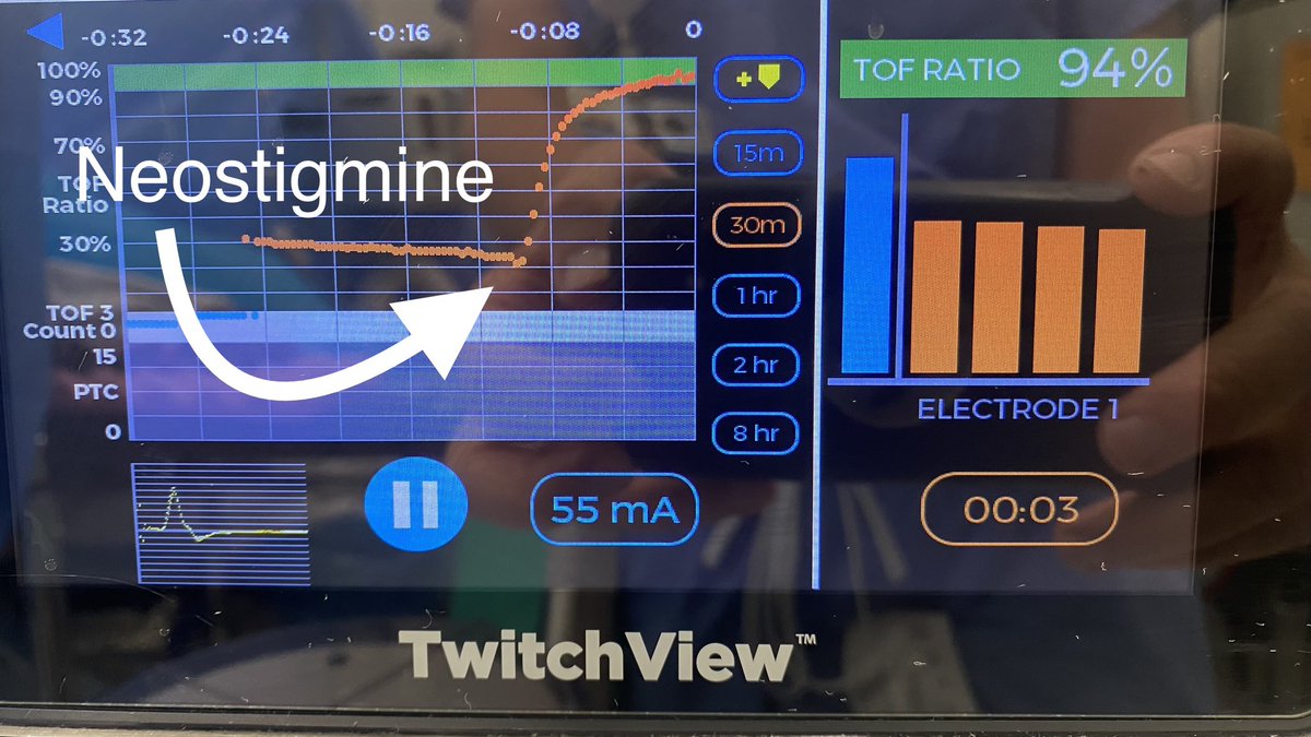 bsojaward's tweet photo. 25% TOF ratio. Reversed with 3mg neostigmine & perfect data capture #precisionanesthesia @BlinkTwitchView @EliseColleenW @aanacrna https://t.co/JgKgGhqnAM