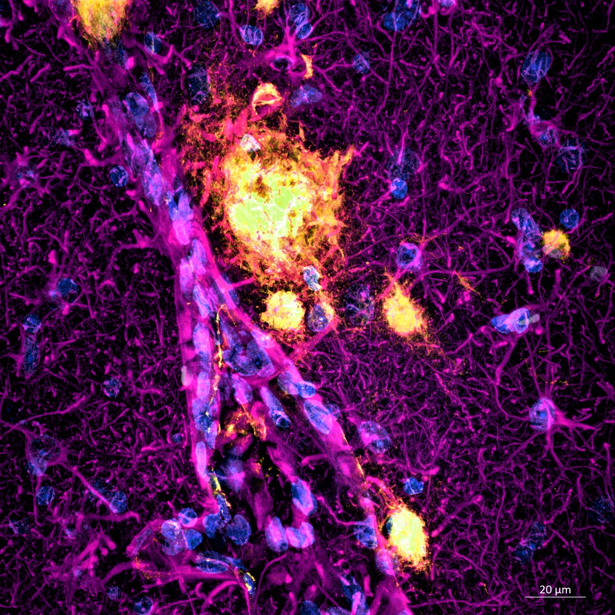 Cerebral amyloid angiopathy: amyloid deposits 🟡 on the walls of blood vessels, a process occurring with aging and #Alzheimers. Notice the reactive astrocytes 🟣 around the blood vessel and, probably, the disrupted blood-brain barrier. Dapi🔵 #neuroscience <a href="/zeiss_micro/">ZEISS Microscopy</a>