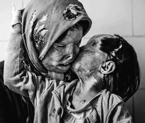 أم إيرانية تدعى “سمية مهرى” وابنتها “رنا” كانتا ضحية زوج وأب متوحش ألقى بمادة اسيد على زوجته وابنتها أثناء نومهم
⬇️⬇️