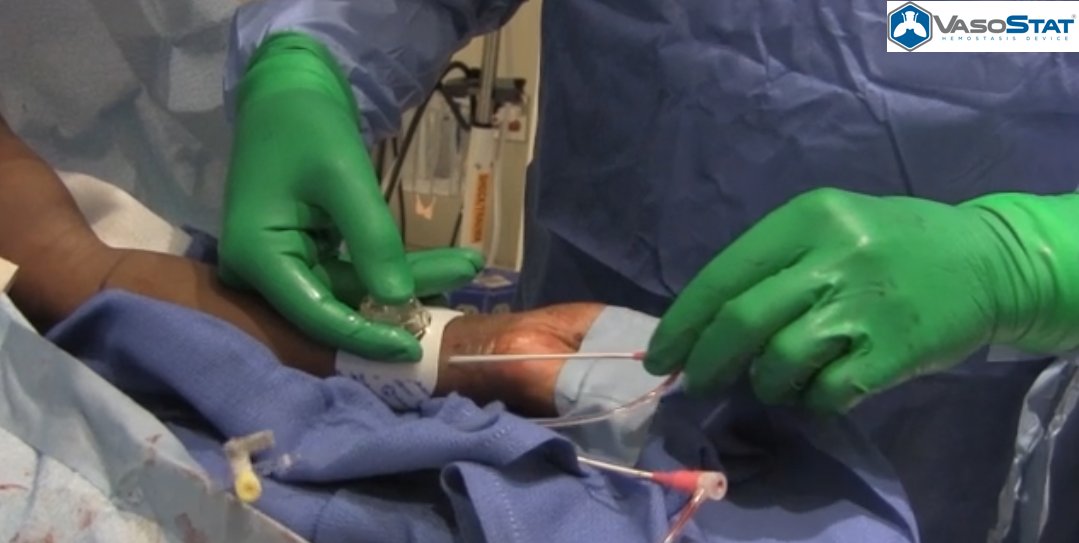 ForgeMedical's tweet photo. #VasoStat mimics manual compression which leads to #hemostasis significantly faster than balloon bands.

#cathlab #radial #distalradial #ulnar #pedal #tibial https://t.co/NPj3rI2nqK