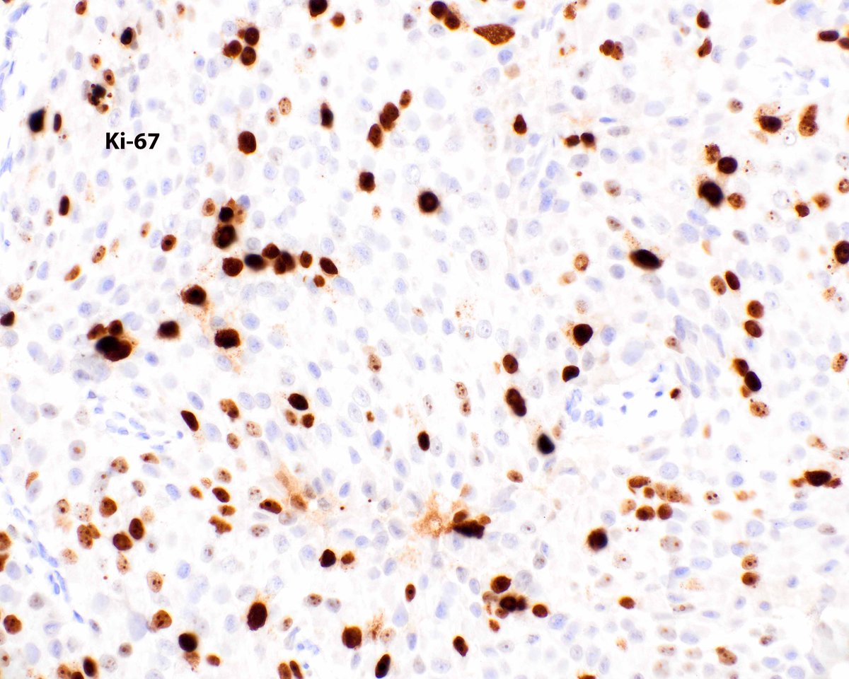Neuroendocrine tumor (NET) grade 3 using Ki-67;  in the past neuroendocrine carcinoma/NEC based on the proliferation index. Therapy differs for G3 NET (somatostatin analogues, mTOR inhibitors, alkylating agents, VEGF inhibitors) versus NEC (platinum based). #UMiamiPath