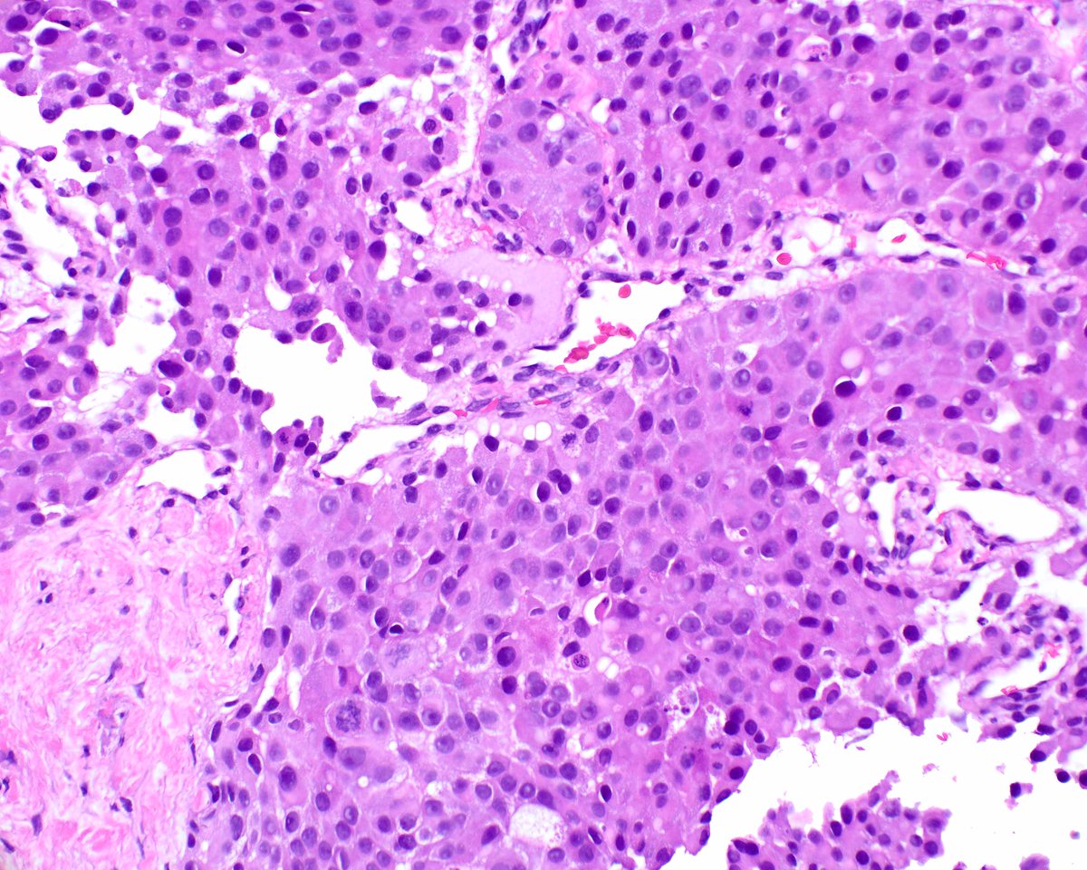 LizMontgomeryMD's tweet photo. Neuroendocrine tumor (NET) grade 3 using Ki-67;  in the past neuroendocrine carcinoma/NEC based on the proliferation index. Therapy differs for G3 NET (somatostatin analogues, mTOR inhibitors, alkylating agents, VEGF inhibitors) versus NEC (platinum based). #UMiamiPath https://t.co/byJswhz6Y5