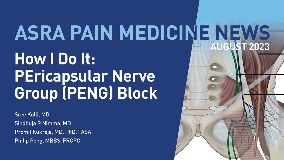 ASRA_Society's tweet photo. Read about the PEricapsular Nerve Group (PENG) block in the latest #ASRANews! The #PENGblock targets sensory innervation to the anterior hip capsule during total hip arthroplasty (#TKA) and hip fractures... the second most common joint replacement surgery! https://t.co/oKEtZlXccY https://t.co/kXrrAyAcjw