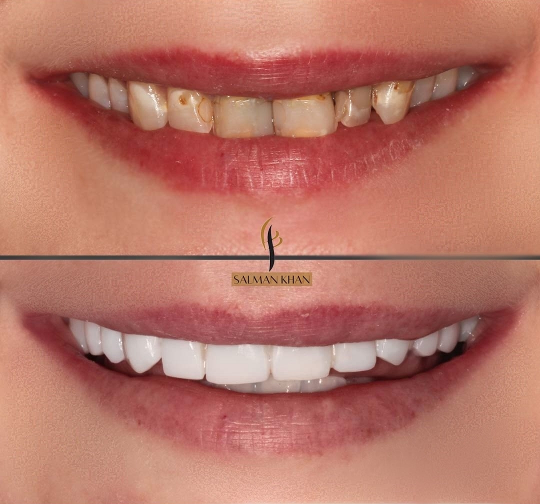 Life-changing smiles are created at Baycliff😁⁠
⁠
𝗛𝗢𝗪 𝗧𝗢 𝗚𝗘𝗧 𝗜𝗡 𝗧𝗢𝗨𝗖𝗛⁠
⁠
📱DM us directly⁠
✉️reception@baycliffdentalsurgery.co.uk⁠
☎️0151 228 2200
        
#compositeveneers #smilemakeover #smiletransformation