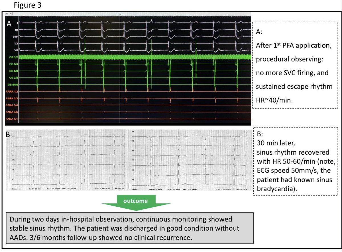 #technical_report Frankfurt 😉@JICE_EP 
‼️ Doable but Careful ‼️

🔺PFA #farapulse SVC Isolation

@hhuang123 @ALFIEEP1 @Ahmed43101178 @Dominik_Linz @jczerpa

@jongichun @BorisSchmidt5 
@purerfellner @Phiso_de @AGEP_DGK @ftrae @drjohnm
@BA_Mulder @MRuwald @DrRoderickTung…