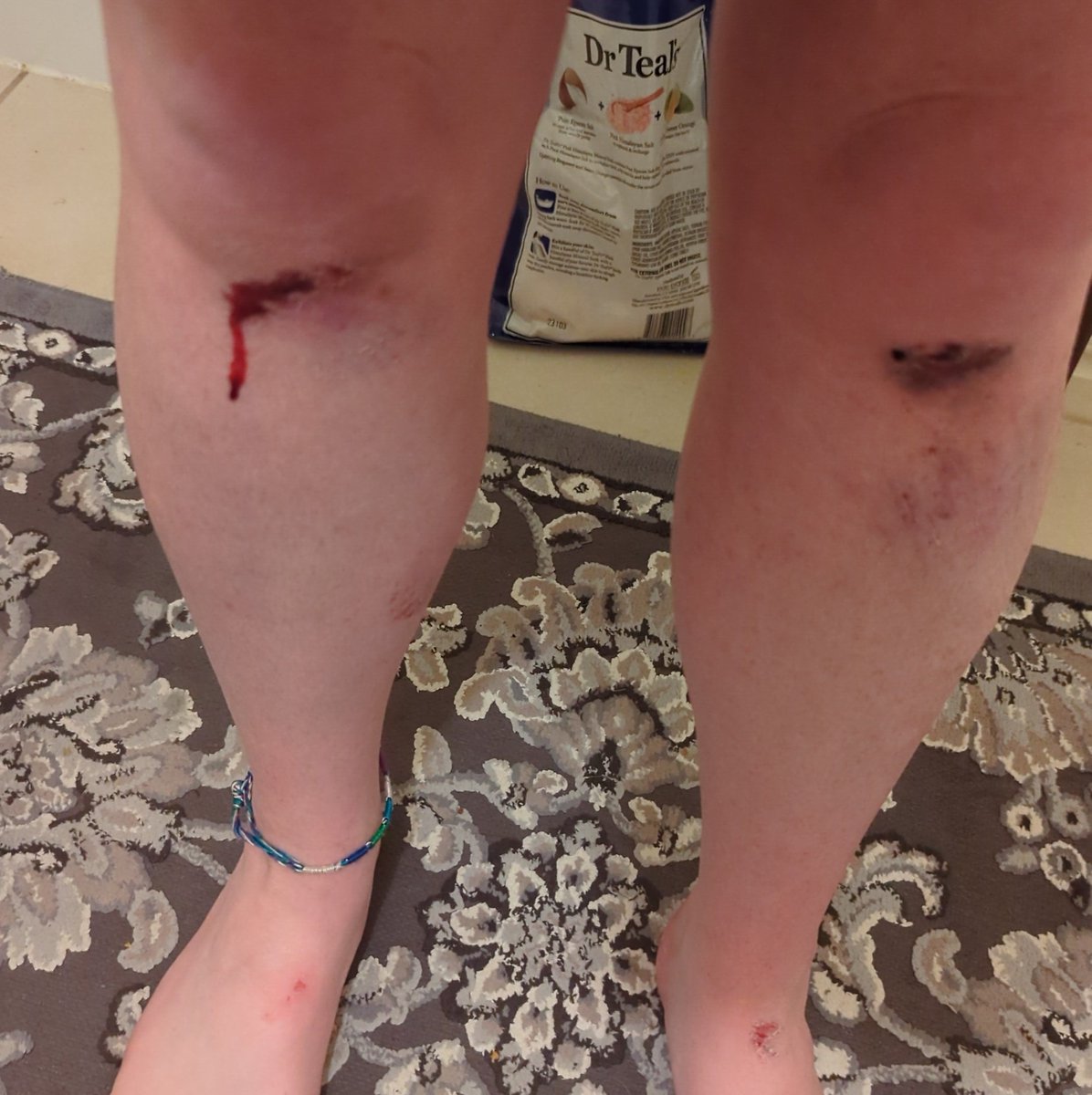 atomicginge's tweet photo. So today I fell off the sidewalk and into the road.. and not only did I absolutely destroy my knees BUT I twisted my ankle too 😬🙃 #imfineeverythingsfine https://t.co/6ePfAXFADy
