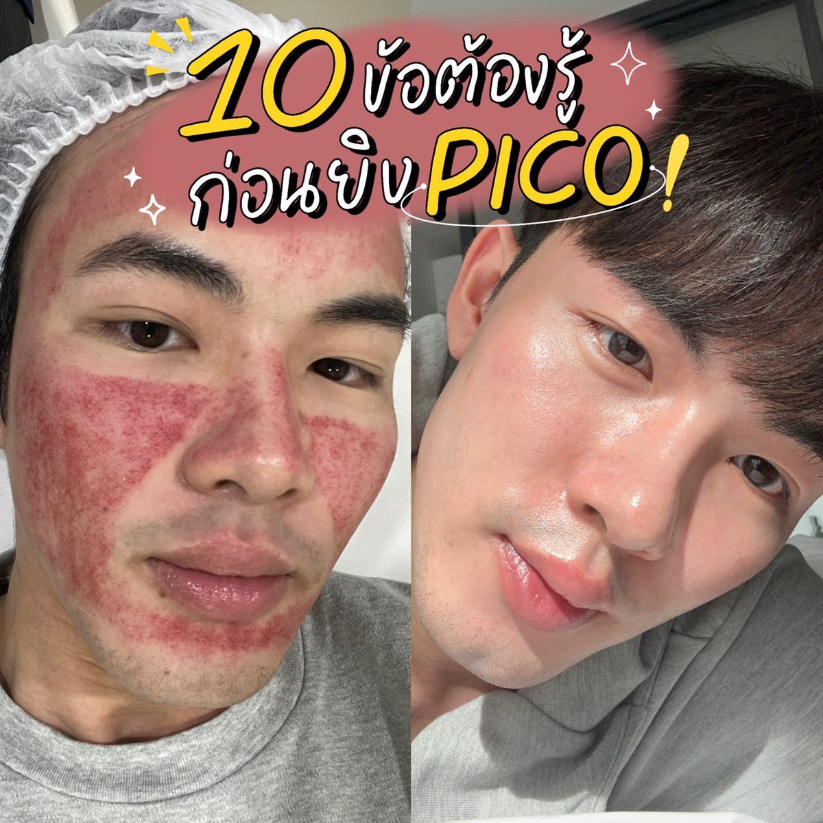 echopwt_'s tweet photo. 📍10 ข้อต้องรู้ ก่อนยิงเลเซอร์ pico 
1.เป็นเลเซอร์ที่เก่งที่สุด! (ณ ตอนนี้) ในการจัดการเม็ดสี (รอยดำ ฝ้า กระ รอยสัก)
2.มีโหมด fractional ที่ช่วยกระตุ้นคอลลาเจน รักษาหลุมสิว กระชับรูขุมขนได้!
3.ไม่ได้ทำให้ผิวบาง!
4.ระยะพักฟื้นน้อย ถ้ายิงแค่โหมด Toning หน้าใสลดรอยดำ 1 วันก็ใช้หน้าได้ปกติ แต่งหน้าได้เลย!
5.หลังทำห้ามล้างหน้า 12 ชม. หลังจากนั้นทาสกินแคร์ แต่งหน้าได้ปกติ
6.เห็นผลเรื่องรอยดำตั้งแต่ครั้งแรก เป็นผลถาวร (ถ้าไม่ได้มีรอยใหม่)
7.ทำซ้ำได้ทุก 2-4 สัปดาห์ เพื่อผลลัพธ์ที่ชัดเจน
8.โหมด fractional รักษาหลุมสิว ไม่ใช่ยิ่งแดงยิ่งดี ต้องประเมินจากปัญหาผิวของแต่ละบุคคล ค่าพลังงานก็แตกต่างกัน
9.ใช้ร่วมในการรักษาฝ้า เพื่อจัดการฝ้าลึกได้ แต่ต้องปรับพลังงานให้เหมาะสม ไม่งั้นฝ้าจะเข้มขึ้นได้!
10.จากข้อ 8 9 จึงต้องทำกับ”แพทย์”ที่เชื่อถือได้ และเชี่ยวชาญทั้งการทำ Pico การตั้งเครื่อง การปรับค่าพลังงาน เท่านั้น!

✨ทุกคนน่าจะรู้กันอยู่แล้วว่า pico คือเลเซอร์แห่งยุคนี้เลยก็ว่าได้ เพราะจุดเด่นที่จัดการรอยดำได้เก่งที่สุด แถมยังเสริมด้วยความสามารถในการกระตุ้นคอลลาเจนรักษาหลุมสิวให้ผิวเรียบเนียน แต่ข้อควรระวัง หรือควรพิจารณาก่อนการทำ คือ เลือกคลินิกที่มีมาตรฐาน ใช้เครื่องแท้ที่ได้รับการรับรอง และทำโดยแพทย์ผู้เชี่ยวชาญจริงๆ เนื่องจากเครื่อง pico สามารถปรับค่าพลังงานได้หลายรูปแบบ หากปรับไม่เหมาะสมก็อาจเกิดผลไม่พึงประสงค์มากกว่าผลดีได้ ดังนั้น “จะมาเป็น pico เหมือนกันไม่ได้!”

💕ส่วนตัวโค่ไว้ใจฝากหน้าไว้กับ DSK clinic เพราะคุณหมอมีความเชี่ยวชาญ และให้คำปรึกษาได้ดี ไม่ใช่ว่าเข้าไปอยากทำอะไรก็ทำได้เลย แต่คุณหมอจะประเมินปัญหาและวางแผนการรักษาร่วมกับเราก่อน (ปัญหาที่เรามี อาจต้องใช้หลายเทคนิคร่วมกัน เพื่อให้ได้ผลลัพธ์ที่ดีที่สุด) ตัว pico ก็ทำต่อเนื่องมา 5-6 ครั้งได้แล้ว ประทับใจในผลลัพธ์ ความหน้าใส ผิวละเอียดขึ้นสุดๆ ใครสนใจก็ลองไปปรึกษาดูก่อนได้นะครับ

“บทความนี้ได้รับการสนับสนุนจาก DSK clinic”
#dskclinic #ทำpicoต้องdsk