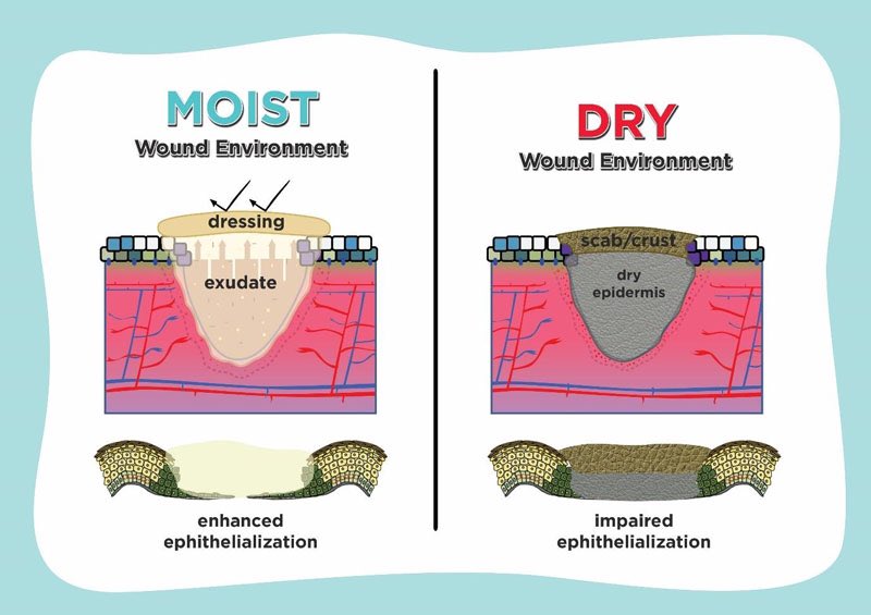 sh_aftercare's tweet photo. moist healing and dry healing.
what’s is it? which one is the best option?
a thread made for educational purposes only !!! https://t.co/bDTpg9Dwzl