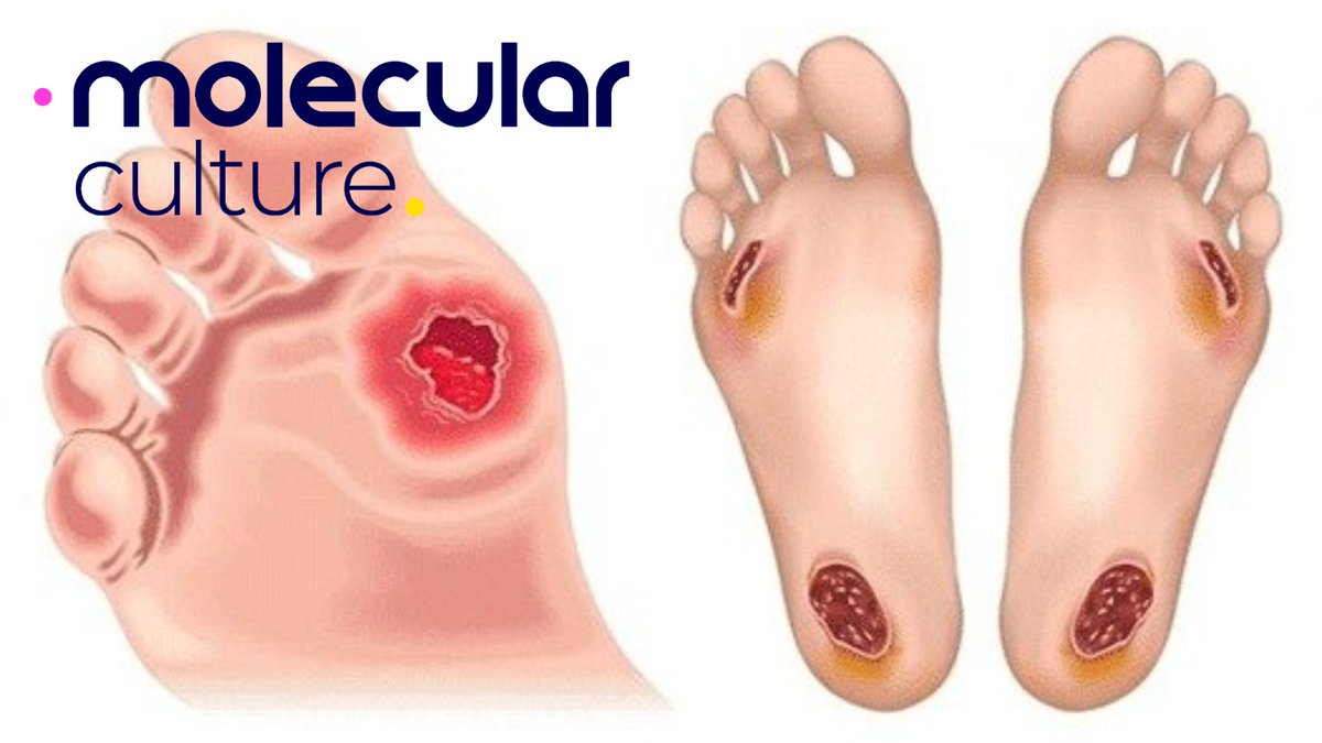 🚨New Study Alert🚨: Unveiling advancements in Diabetic Foot Osteomyelitis (DFO) diagnostics. Dive deeper into our findings: 
lnkd.in/e4HW8mkx 🩺✨ #inbiome #MolecularCulture #PrecisionMedicine #HealthTech #BeBoPTrial #RapidDiagnostics