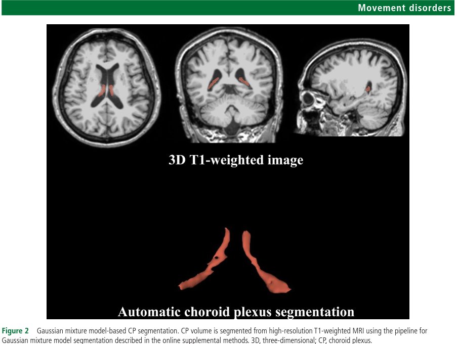 JNNP_BMJ's tweet photo. How interesting, did you know that increased size of choroid plexus, that unpleasant looking mass of vessels in the cerebral ventricles, is linked to neurodegeneration severity in Parkinson's disease. 

If you're as interested as I am, read more here 👇 👇
https://t.co/v18wqwW0Lm https://t.co/viMW3NssYP