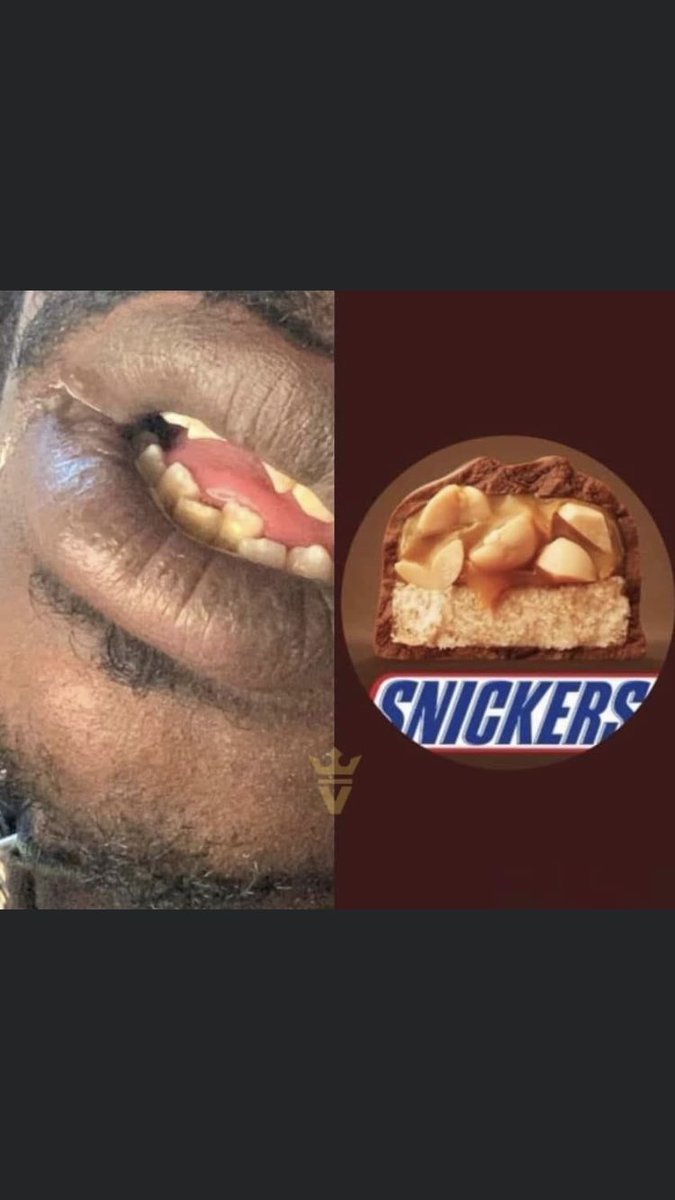 <a href="/solsagramz/">SOLSA</a> <a href="/HoodzODM/">THE FINAL BOSS</a> teeth 😂