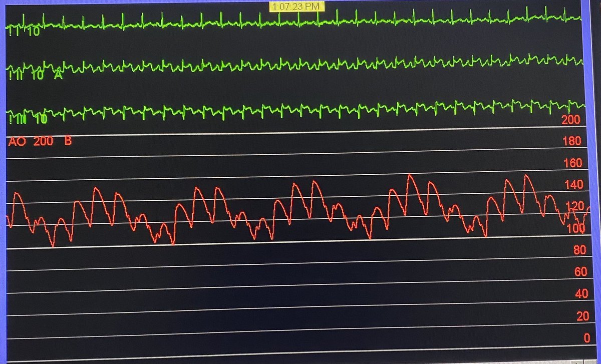 Patient undergoing RCA CTO angioplasty. No fluid in pericardial cavity. BP subsequently fell to 80.