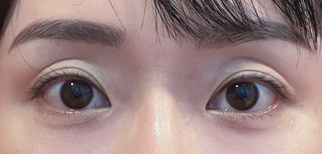 mimitan090909's tweet photo. 浦和OZIスキンクリニックの王子先生 @TomitoOJI の所に埋没カウセで伺ったら「埋没は不要」で、凹み目の症状に二子玉川あきこクリニックを推薦していただいた🤣（心から好きなドクター👨‍⚕️）

眼下脂肪が元々いた深い位置にヒアルロン酸1CC注入していただいたんだけど劇的ビフォーアフターすぎて感動😭✨ https://t.co/bv4vR4Ng9C