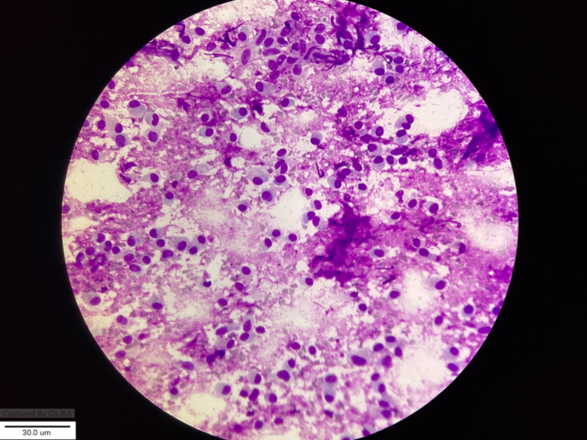 marquess_raj's tweet photo. 20 M,Cheek swelling #Cytoquiz 
Which city will you think about 🤔
https://t.co/vxj1NcG0sk 
B.Milan 
C. Benign
 D. Both B &amp; C 
2.What stain is demonstrates chondromyxoid fragments best ?
A. PAP
B.Geimsa
C. May - Grunwald 
D. Leishman 🎨3 https://t.co/5u0OJtfdLF