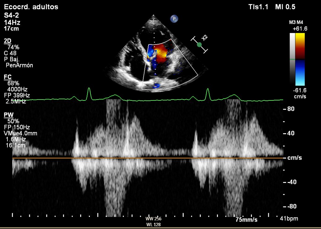 Imagen Cardiaca H12O (@imagcardio_h12o) on Twitter photo ¿Te atreves a dar un diagnóstico solo con este registro? ¡Los cardiólog@s de vacaciones también pueden opinar! #MañanadeDoppler #DopplerMorning #echofirst #CardioTwitter <a href="/drsoliscardio/">Jorge Solís</a> <a href="/SamanthaWasnie1/">Samantha Wasniewski</a> <a href="/alexsfelixecho/">Alex Felix</a> <a href="/rafavidalperez/">rafavidalperez</a> <a href="/VDelgadoGarcia/">Victoria Delgado</a> <a href="/Cardio_H12O/">Servicio Cardiología Hospital 12 de Octubre</a> ¿Te atreves a dar un diagnóstico solo con este registro? ¡Los cardiólog@s de vacaciones también pueden opinar! #MañanadeDoppler #DopplerMorning #echofirst #CardioTwitter <a href="/drsoliscardio/">Jorge Solís</a> <a href="/SamanthaWasnie1/">Samantha Wasniewski</a> <a href="/alexsfelixecho/">Alex Felix</a> <a href="/rafavidalperez/">rafavidalperez</a> <a href="/VDelgadoGarcia/">Victoria Delgado</a> <a href="/Cardio_H12O/">Servicio Cardiología Hospital 12 de Octubre</a>