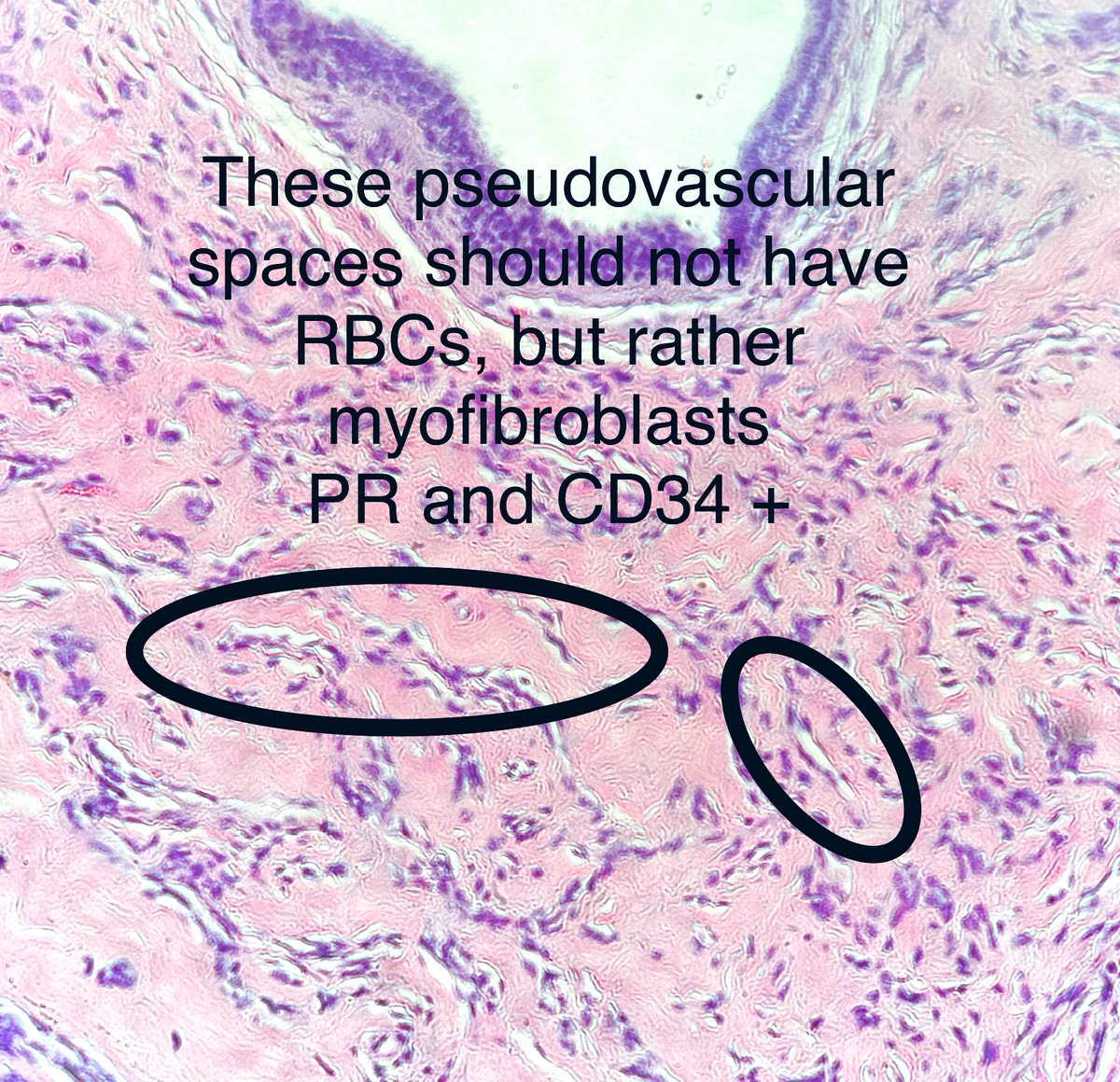 Not every breast mass is cancer

PASH: pseudoangiomatous stromal hyperplasia (now say that 10 times while running backwards) 

#pathx #breastx #pathology #medx #familymed #surgx #gensurg