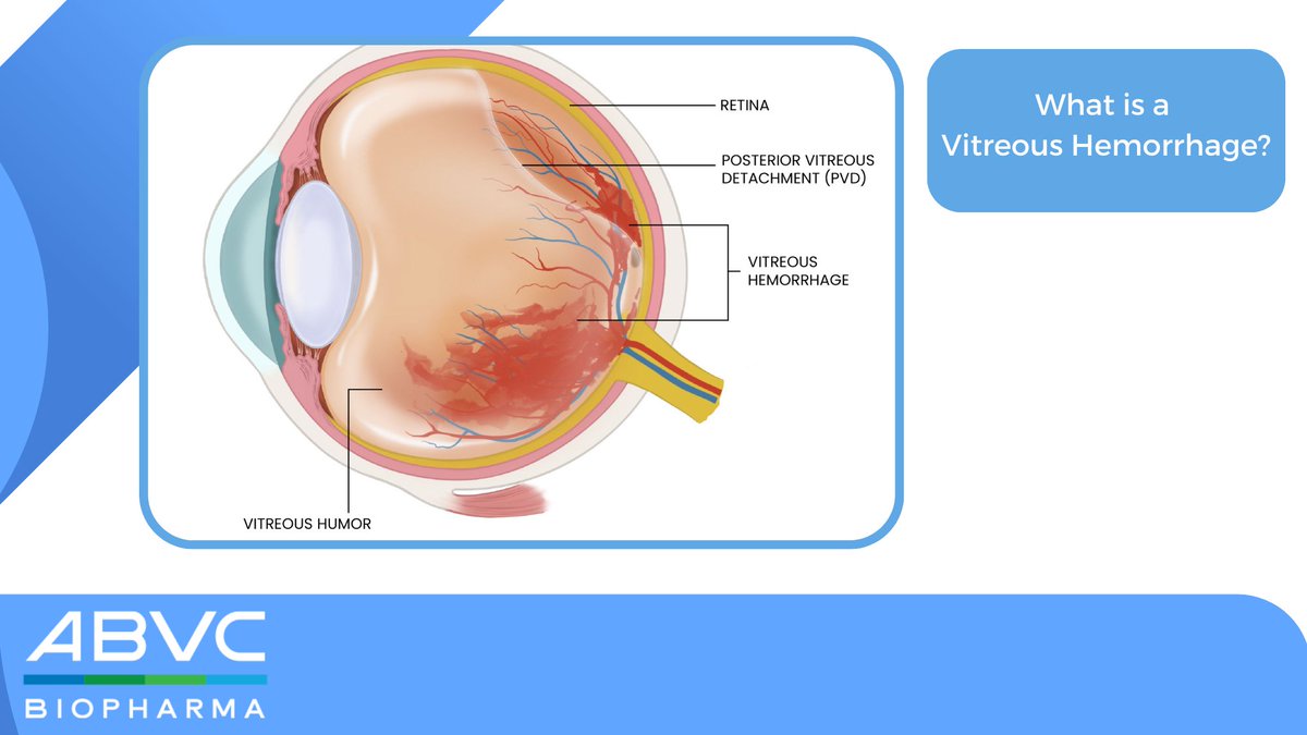 ABVCBioPharma's tweet photo. A vitreous hemorrhage is bleeding into the thick fluid that fills the center of the eye, the vitreous. The gel is clear, so light passes through it to the retina. The retina is the nerve layer at the back of the eye that sends images to your brain.   

$ABVC #ophthalmology https://t.co/ABoFsrCOna
