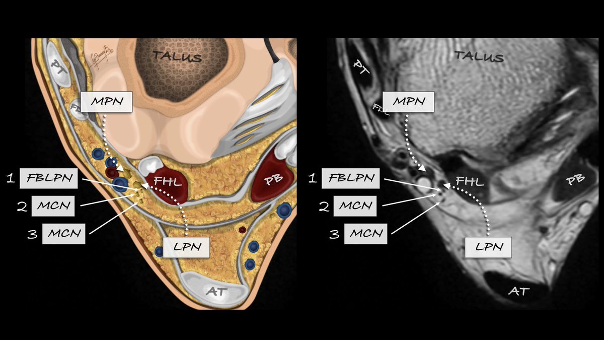 GSERRANOB_MSK's tweet photo. Comparative images of Baxter’s nerve, MRI versus illustration. 

The medial plantar branch (MPN) has an anterior location, and it must be differentiated from the lateral plantar branch (LPN), which is located posteriorly. Once the LPN has been identified, we follow it, and we will see that the first branch (FBLPN/Baxter) origins from its posterior margin. More cranially, before the division of the plantar rami of the tibial nerve (or sometimes already divided), the medial calcaneal nerve originates.

Then it's just a matter of following the “small dots.”

#mskrad