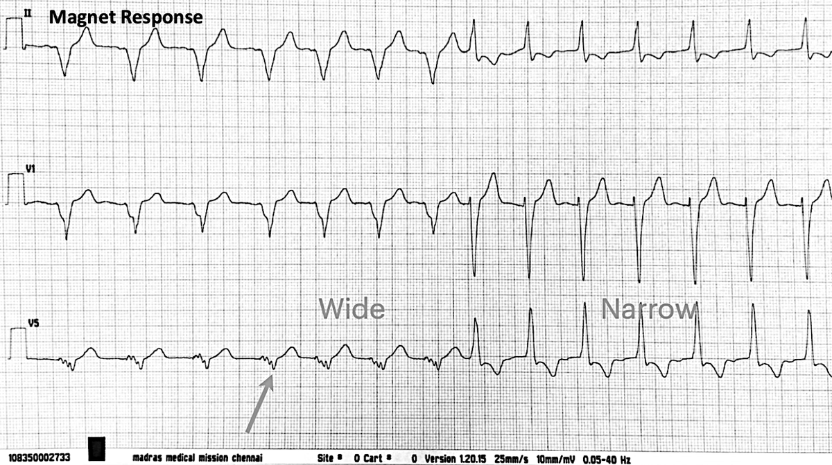 DDD. Baseline and Response to Magnet. How to explain? <a href="/narrowQRS/">JMC</a> <a href="/jeffrey_vinocur/">Jeffrey M Vinocur</a> <a href="/syamkumarmd/">Syamkumar</a> <a href="/SchakrabartiEP/">Shanta Chakrabarti</a> <a href="/Hapa_EP/">Kevin Brady</a> <a href="/EPeeps/">e__peeps</a> <a href="/UlhasDr/">Dr Ulhas Pandurangi</a> <a href="/HaranBurri/">Haran Burri</a>