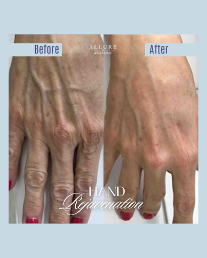 MyRenuva's tweet photo. With #Renuva, you can replenish age-related volume loss, camouflaging the prominent veins that often appear in our hands with age and bid farewell to wrinkly hands.

These beautiful results are courtesy of the Renuva elite injectors at Allure Aesthetics.

📷 @allureaestheticsfl https://t.co/shm2iFiIoh