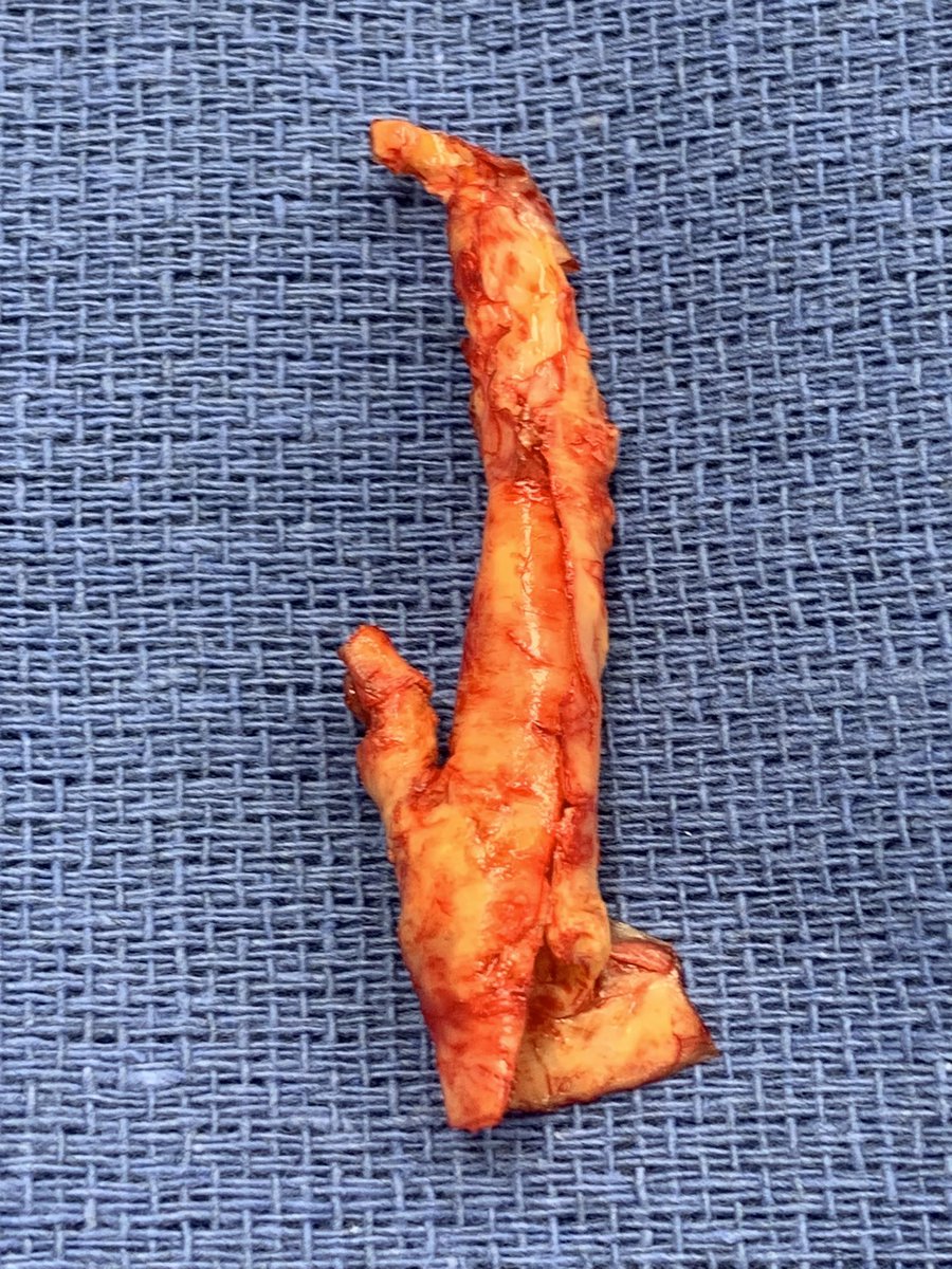 No conduit was utilized with this carotid endarterectomy