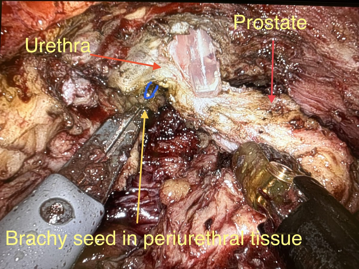 Most patients S/P radiation say there was no complications discussion. This is a simple cystectomy- bladder cripple S/P brachy +XRT boost complicated by stricture, incont., infection… Picked multiple seeds from urethra. Unfortunately same story: No discussion of complications.