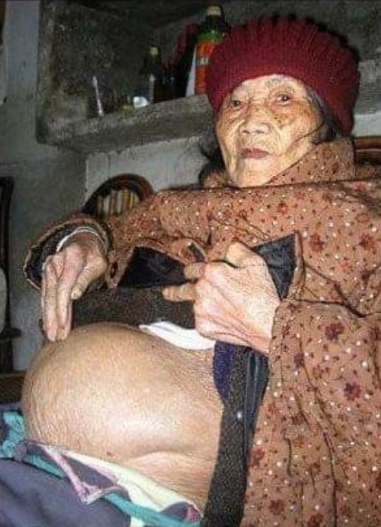 In 1948, Huang Yijun, a 31-year-old Chinese woman, discovered that she was pregnant. She went to the doctor, who informed her that the fetus was growing outside her uterus, specifically in her abdomen, a condition known as ectopic pregnancy.

Huang needed to undergo surgery to