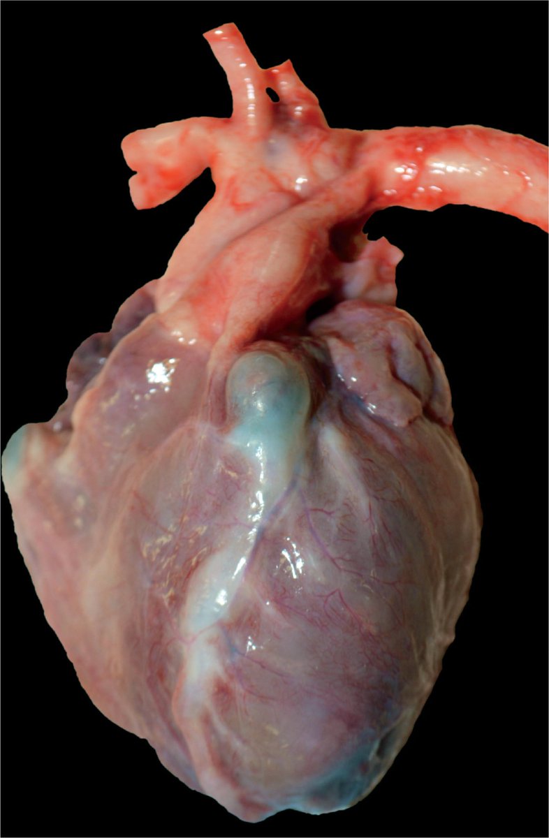 med_712's tweet photo. A 5-year-old boy presents to the emergency room with 5 days of fevers

Diagnosis?

And what’s the criteria for diagnosis? https://t.co/u1pfHN44wS