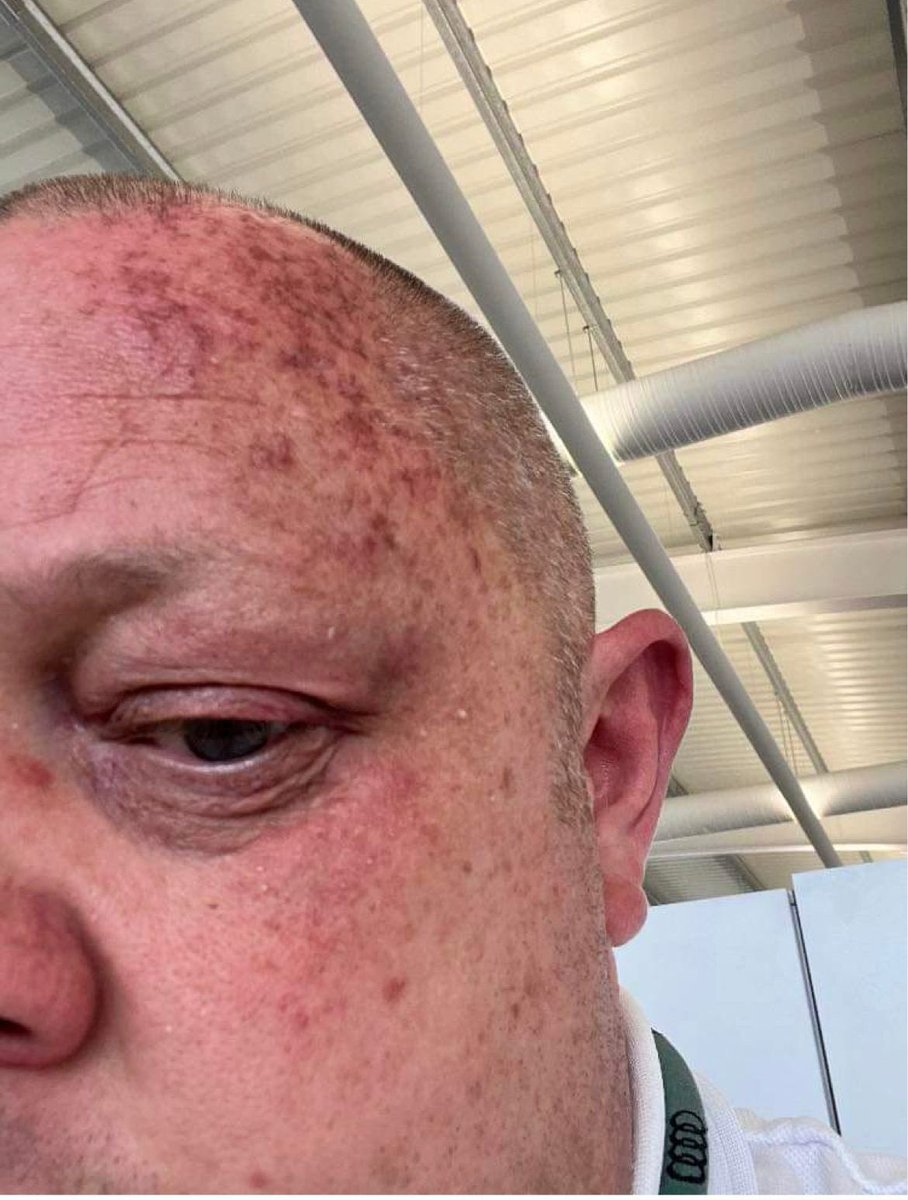 afowler06's tweet photo. Wow 🤩 ANOTHER ONE,  Isn’t it mental I’m changing peoples lives with @supreme_cbd when they say the doctors can’t,  which is sad to say but they should be subscribing quality CBD,  this psoriasis cream from @supremecbd is amazing 💚 check it out on https://t.co/GecQerzCas 🔥 https://t.co/ycWBuHd9m9