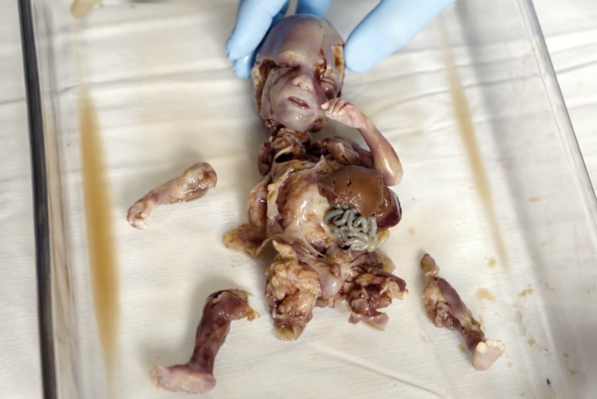 LilaGraceRose's tweet photo. @LiveAction In 2022, the same pro-life activists discovered 115 aborted babies in a bin outside of the same abortion facility.

Five were nearly full-term babies.

This is the “reproductive health care” that these pro-life activists were obstructing. https://t.co/2Uy4HTvYtE
