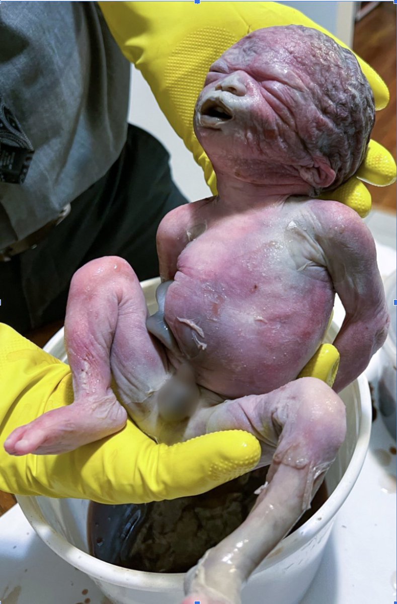 @LiveAction In 2022, the same pro-life activists discovered 115 aborted babies in a bin outside of the same abortion facility. Five were nearly full-term babies. This is the “reproductive health care” that these pro-life activists were obstructing.