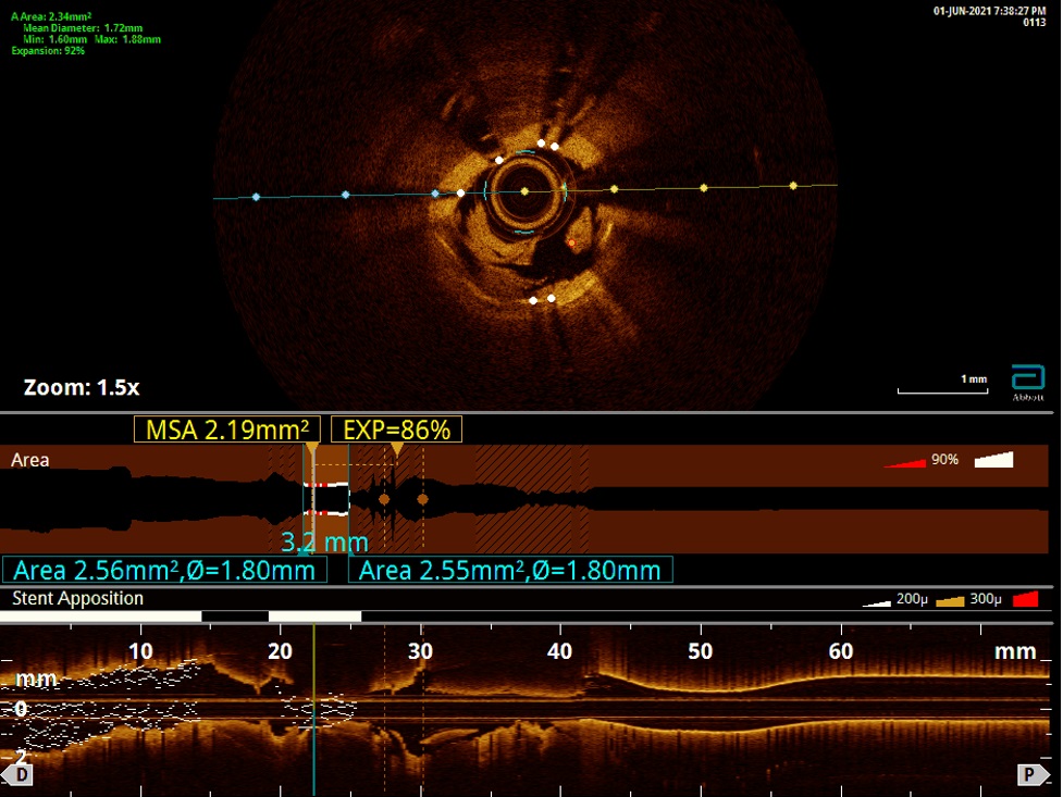 DeBakey CV Education - World Class CV Training (@debakeycvedu) on Twitter photo Shock & Awe: Successful Revascularization w/ Intravascular Lithotripsy in Recurrent ST-Elevation MI Secondary to Stent Under-Expansion - <a href="/PramodPonna/">Pramod Kumar Ponna</a> <a href="/achalasiaaa/">Akhilesh Gonuguntla</a> Ramya Krishna Botta <a href="/TimAFischellMD/">Tim A. Fischell, M.D</a> <a href="/AKassier/">Adnan Alexander Kassier, MD. FACC. FSCAI</a> Sruthi Kotaru <a href="/YashAgrawalMD/">Yashwant Agrawal. MD, FACC, FSCAI</a>
#DeBakeyCVJournal doi.org/10.14797/mdcvj… Shock & Awe: Successful Revascularization w/ Intravascular Lithotripsy in Recurrent ST-Elevation MI Secondary to Stent Under-Expansion - <a href="/PramodPonna/">Pramod Kumar Ponna</a> <a href="/achalasiaaa/">Akhilesh Gonuguntla</a> Ramya Krishna Botta <a href="/TimAFischellMD/">Tim A. Fischell, M.D</a> <a href="/AKassier/">Adnan Alexander Kassier, MD. FACC. FSCAI</a> Sruthi Kotaru <a href="/YashAgrawalMD/">Yashwant Agrawal. MD, FACC, FSCAI</a>
#DeBakeyCVJournal doi.org/10.14797/mdcvj…