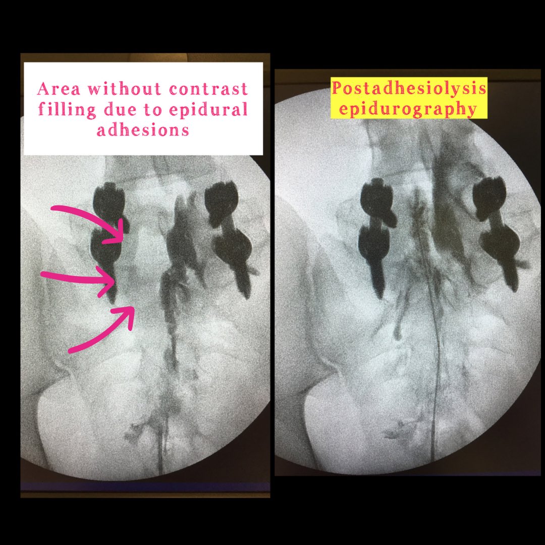 🔵Epidural neuroplasty🔵

✅Normal epidurogram=Christmas tree pattern
❌Abnormal epidurogram=areas where the contrast does not fill epidural fibrosis

🚨Evidence for postlumbar surgery syndrome

<a href="/ClinicaEdolor/">ClinicaEdolor</a> Pain Center <a href="/quironsalud/">quirónsalud</a> Bizkaia Vitoria
#painrelief #pain