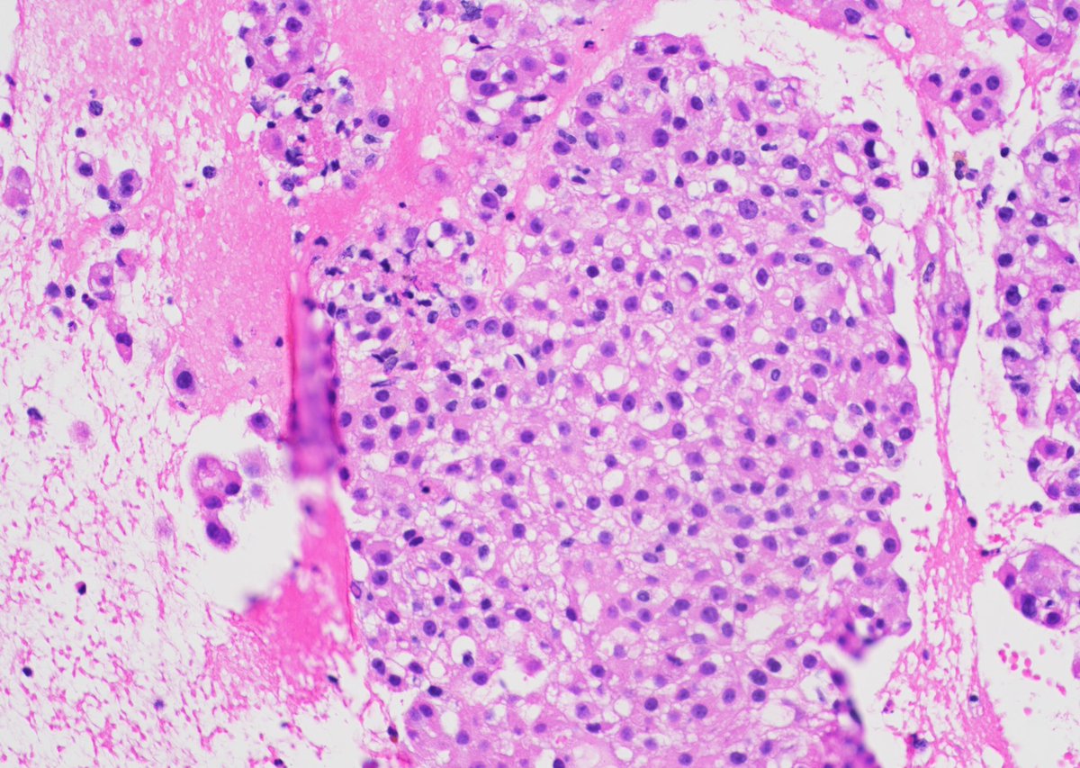 Lymph node with metastasis-
Clear Renal Cell Carcinoma 
Positive for Pax8/CAIX/CD10

#cytology #PathTwitter #pathology #metastasis #surgicalpath