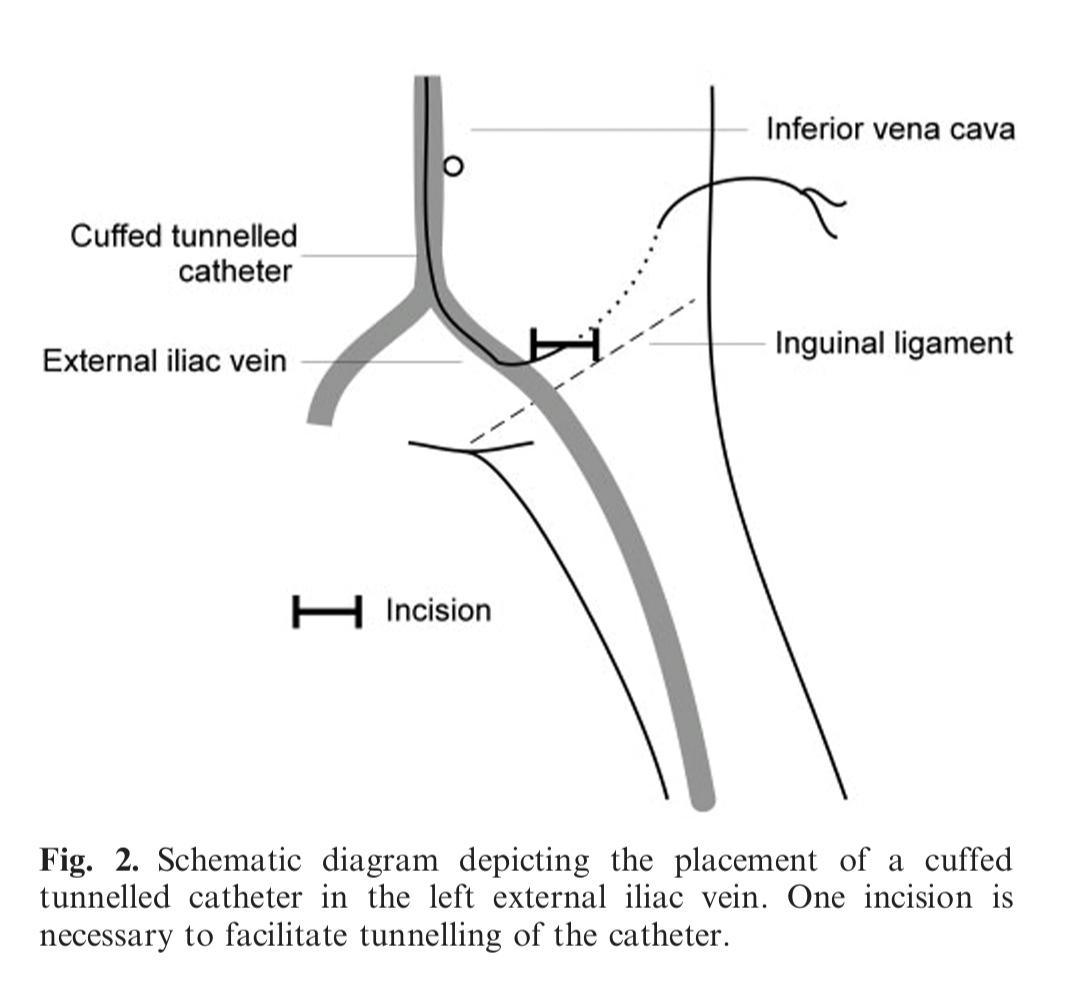 At @nefrohgr46 we have started to use external iliac veins as an alternative to place cuffed tunnelled catheters in patients with central vein stenosis.

Suggested literature:
doi:10.1093/ndt/gfl176

#Nephrology #InterventionalNephrology #Hemodialysis #VascularAccess