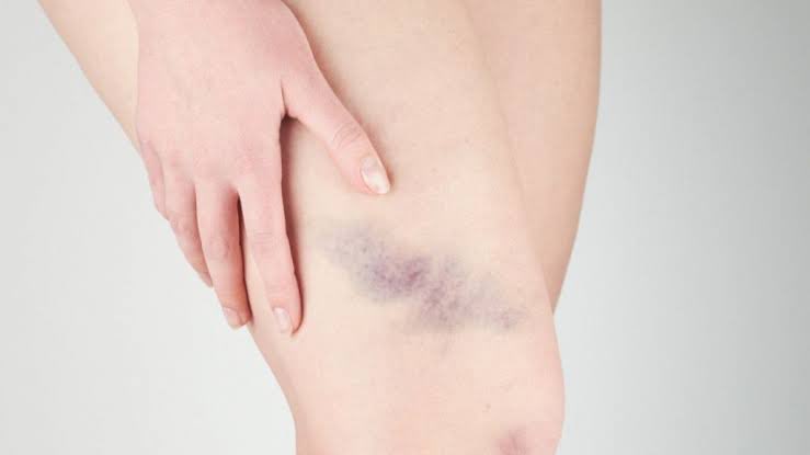 Tau gak sih?
Buat kamu yg suka tiba-tiba memar tanpa sebab, bisa jadi krn kamu kekurangan VIT C!!!
Siapa nih yg gak ngapa2in atau bangun tidur tbtb badannya biru2 memar gitu?
Kalau itu kamu, ini thread buat kalian.
Simak!