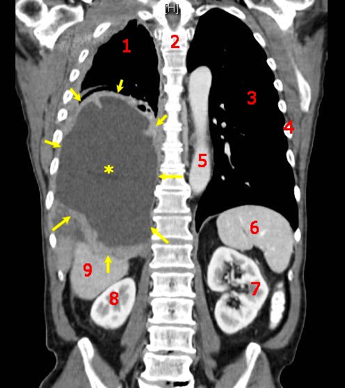 68 y/o M Worker
With shortness of breath, voice hoarseness and pleural effusion. 
Imaging and Cytology below:

Cells are + for EMA, Calretinin 
With BAP1 mutation 

Dx?  
#ctsurg #thoracicsurg #pathx #pulmx #medx #medstudentx #cytox #pathology