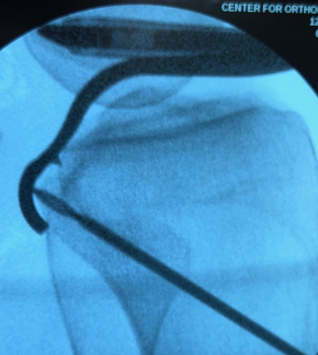 ShybutMD's tweet photo. More complex cases this week: Posterior Cruciate Ligament reconstruction + Posterolateral Corner Reconstruction. #knee #arthroscopy #scoi #sportsmedicine #meded #losangeles_city #socal #california #ortho #orthopedics #PCL #PLC #doublebundle @SCOIOrthoNews https://t.co/vhivhdZrgh