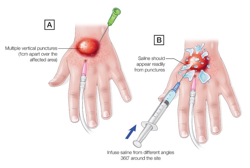 What is the difference between #infiltration and #extravasation 

كلها من مضاعفات العلاج الوريدي او الابرة الوريدية ، في كل الحالتين يصير تسريب للعلاج من خارج الوريد للأنسجة المحيطه فيه لكن الفرق بينهم يعتمد على نوعية العلاج : 

Infiltration : 
اذا كان العلاج non-vesicant ما يسبب