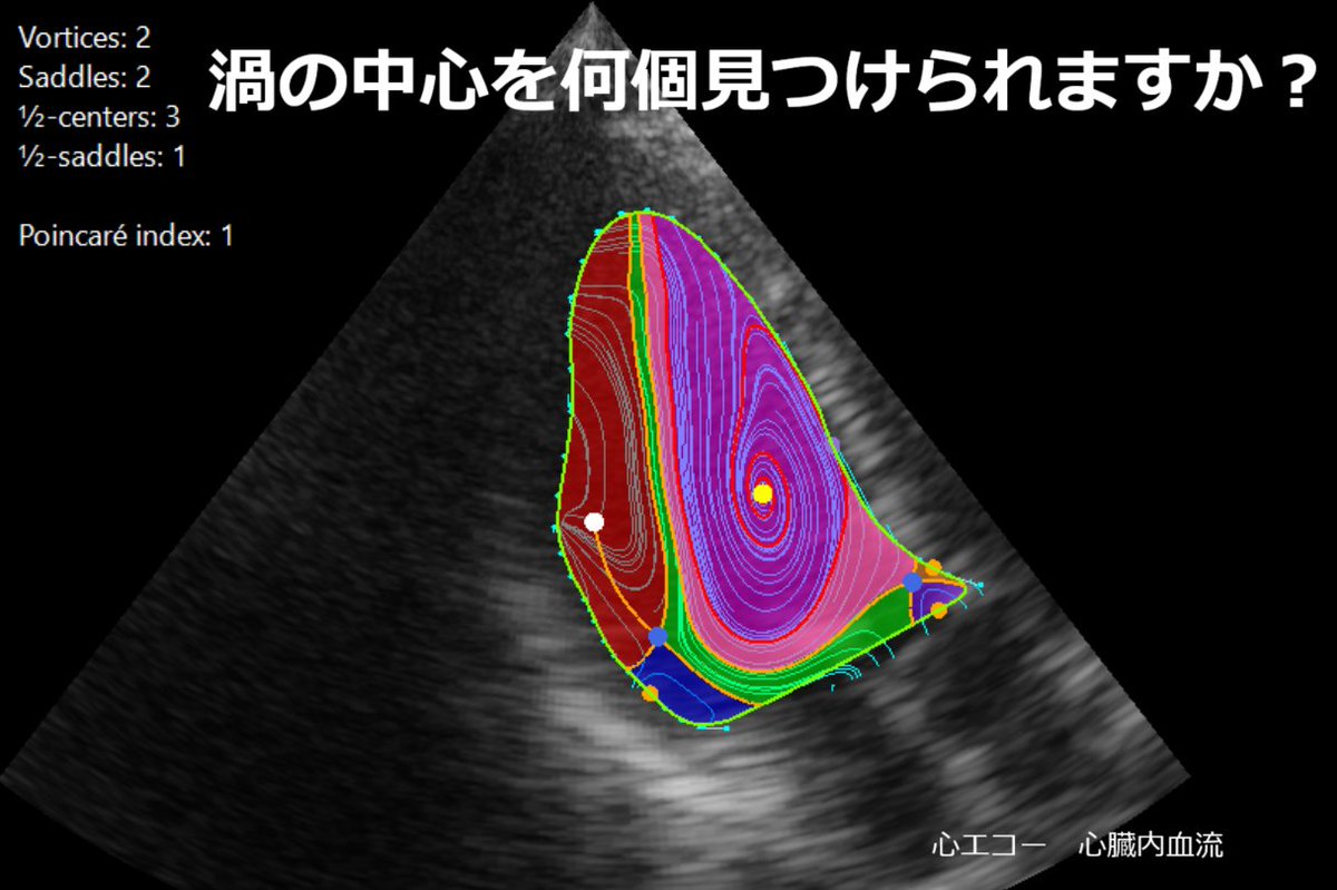 CFD_Inc's tweet image. 渦の中心を何個発見できますか？

心臓内の『渦血流』を同定する理論を世界に先駆けて構築：心血流の渦のパターンを文字化し、早期に心不全を発見する可能性
jst.go.jp/pr/announce/20…

#心臓は血流で診断する時代へ #血流解析 #VFM #カーディオフローデザイン #心エコー #心不全 #早期発見