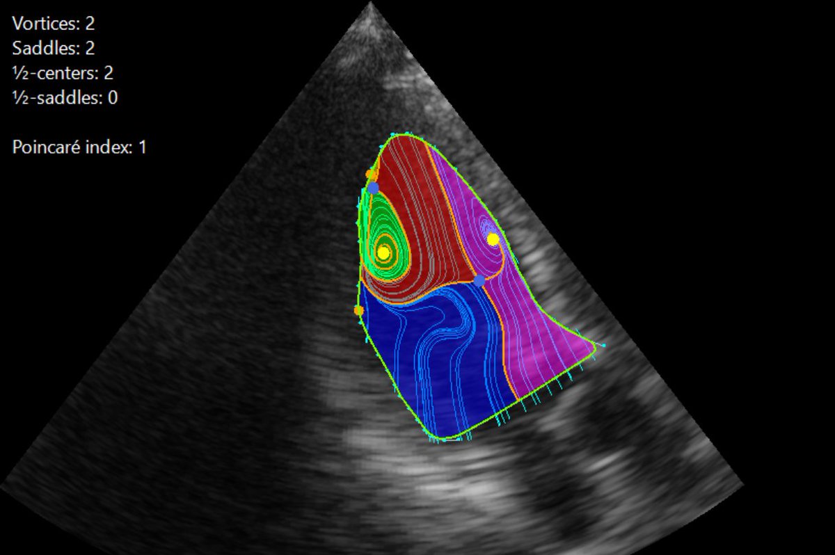 CFD_Inc's tweet image. 渦の中心を何個発見できますか？

心臓内の『渦血流』を同定する理論を世界に先駆けて構築：心血流の渦のパターンを文字化し、早期に心不全を発見する可能性
jst.go.jp/pr/announce/20…

#心臓は血流で診断する時代へ #血流解析 #VFM #カーディオフローデザイン #心エコー #心不全 #早期発見
