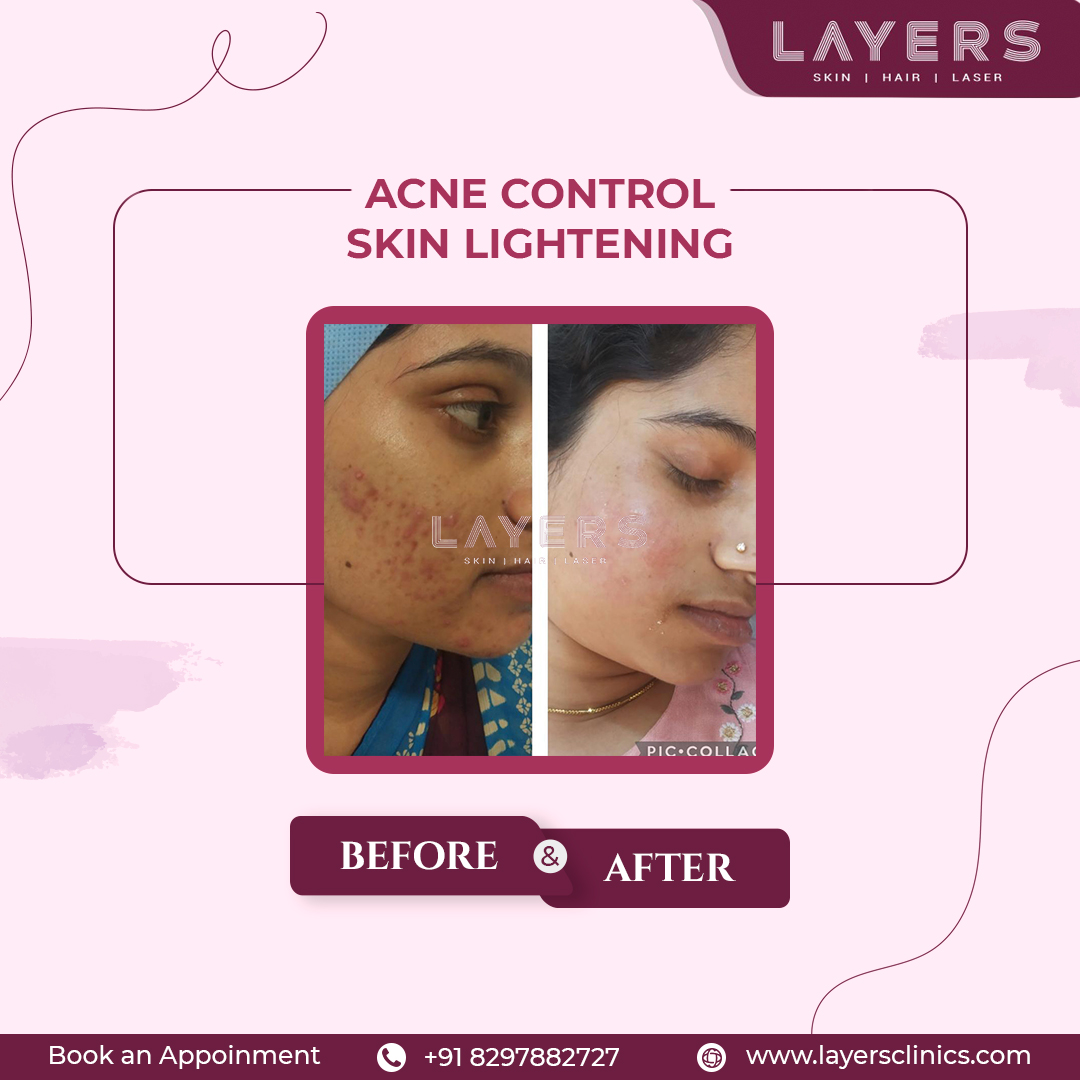 layersclinic's tweet image. Transform Your Skin with Layers Clinic Explore the Magic of Acne Control and Skin Lightening through Before and After Pictures. Reveal Your True Radiance Today! Book an Appointment: 8297882727
#acnecontrol #layersclinics #skinlightening #beforeandafter #layersclinic #radiantskin