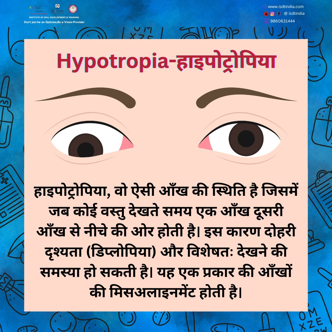 isdtindiacdo's tweet image. हाइपोट्रोपिया:जब आँखें नीचे की ओर देखती हैं।क्या आपने कभी इस अद्वितीय नेत्र स्थिति के बारे में सोचा है? आइए साथ में खोजते हैं! Discovering Hypotropia:When Eyes Look Downward.Ever wondered about this unique eye condition?Let's explore together! #EyeHealth #Hypotropia #EyeCondition