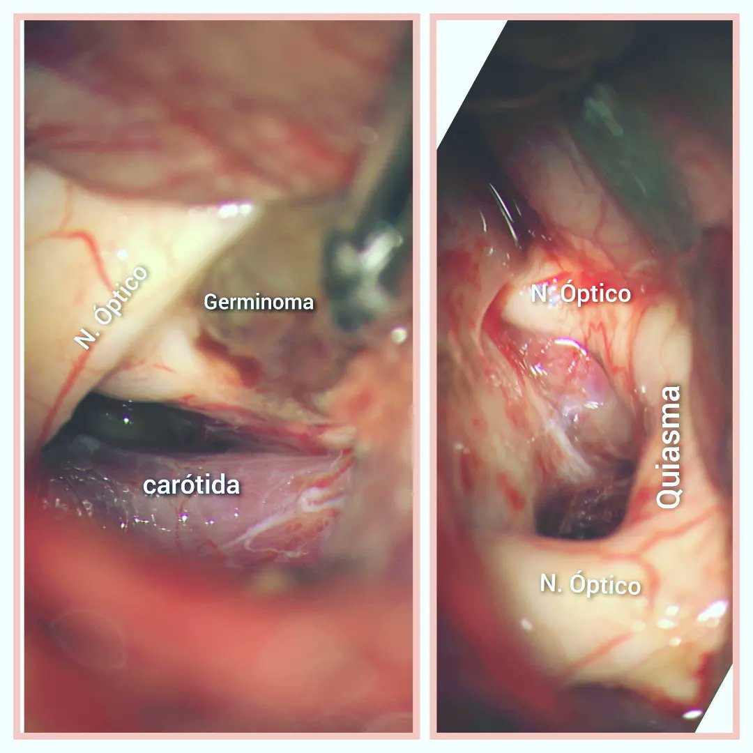 Descompresión de la via óptica en niña con tumor cerebral ciega.