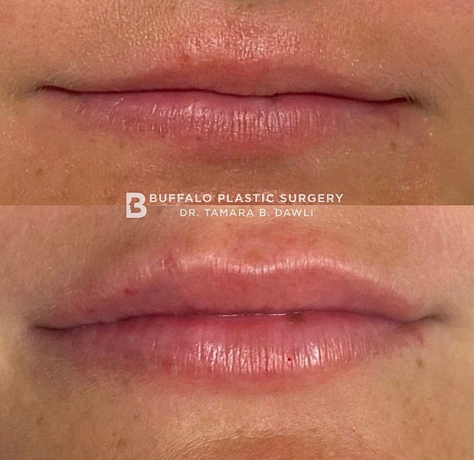 Balancing her lips 👄 #filler  
📸Shared with patient permission⁠
📞 Phone: 716.821.2935⁠
📧Email: info@buffaloplasticsurgery.com⁠
🖥️ Website: buffaloplasticsurgery.com⁠
📍 Location: Buffalo, New York⁠

#lipaugmentation #lipenhancement #drdawli #MedSpa⁠
#fulllips