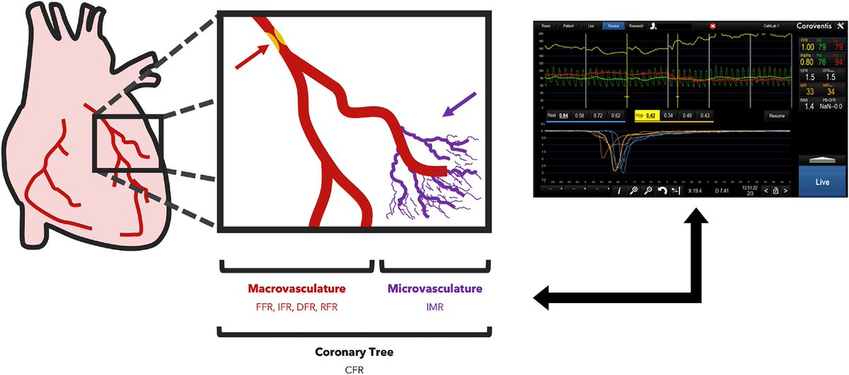 Congratulations to @BCase07, @DorBen @ron_waksman @HashimHayder et al. on their recent publication in @AmJCardio!

Understanding Patient Characteristics and Coronary Microvasculature: Early Insights from the #CMD Registry

sciencedirect.com/science/articl…