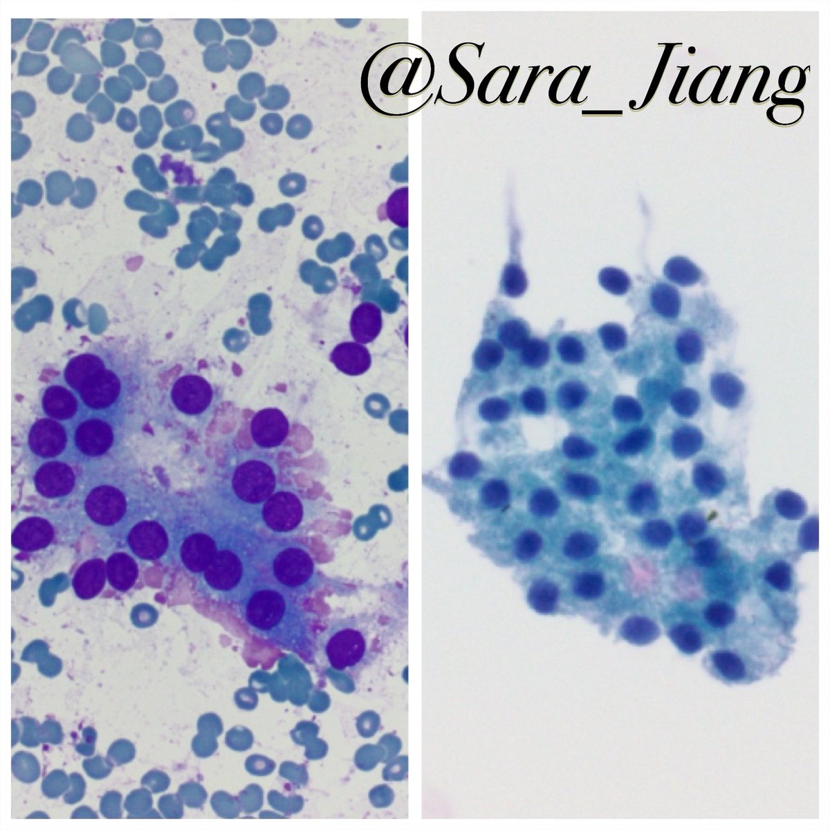Today’s #FNAFriday #DQvsPAP!

A #Thyroid finding: 
🔥Flame cells- associated with Graves dz but non-specific-also seen in hot nodules or just active follicles

👀 Magenta globular edges best seen on DQ (L)
🔎 Pap (R) may show “ragged” edges but much harder to appreciate flames 🔥