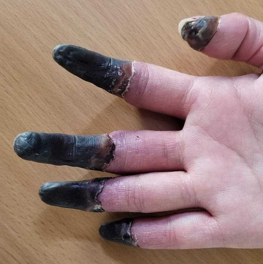 !!!!Сэрэмжлүүлэг‼️‼️ Мэс заслын эмч Л.Нанжид‼️
Энэ удаагийн сэрэмжлүүлгийг эцэг эхчүүд та бүхэн сайтар үзэж тунгаагаад өсвөр насны үр хүүхдүүддээ өөрсдийнхөөрөө сайтар ойлгуулж өгөөч гэж гуймаар🙏🏻🙏🏻🙏🏻 байна. Сүүлийн үед өсвөр насны хүүхдүүд эцэг эхийн хараа хяналтаас гадуур