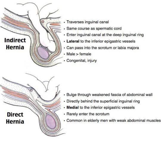 donnperidon's tweet photo. Indirect vs Direct Hernia
#Oct2023PLE https://t.co/MudNxQ1AaN